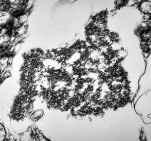 M,71y. | Alzheimer diseaseaccompanied with CADASIL - hyaline body in astrocyte